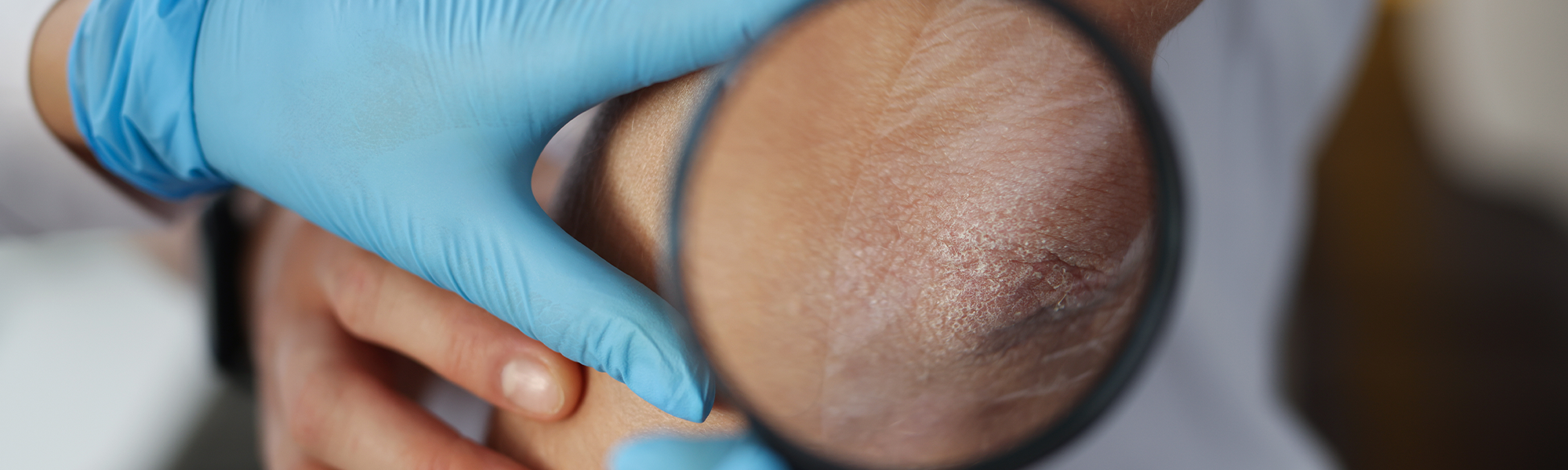 Radiation Dermatitis